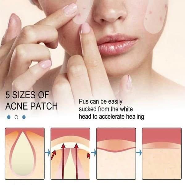 REMENDO PARA ACNE - Imagem 2