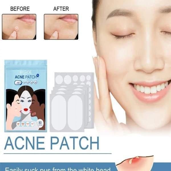 REMENDO-PARA-ACNE.jpg REMENDO PARA ACNE - Imagem 1